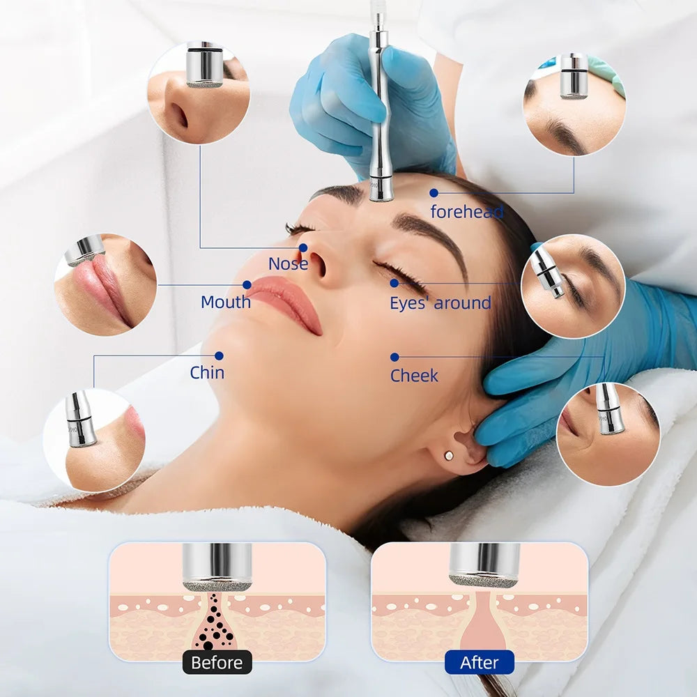 Avelena | Gesichts Haut Peeling Mitesser Entferner