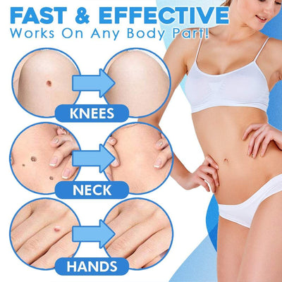 WarzenWeg™ Schmerzfreie Warzenentfernung